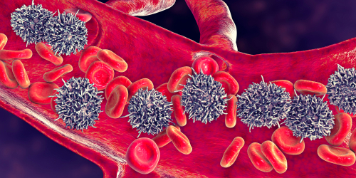 Covid-19 nei pazienti affetti da leucemia mieloide acuta