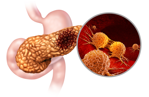 Autofagia: ecco come le cellule degli adenocarcinomi duttali sfuggono al sistema immunitario