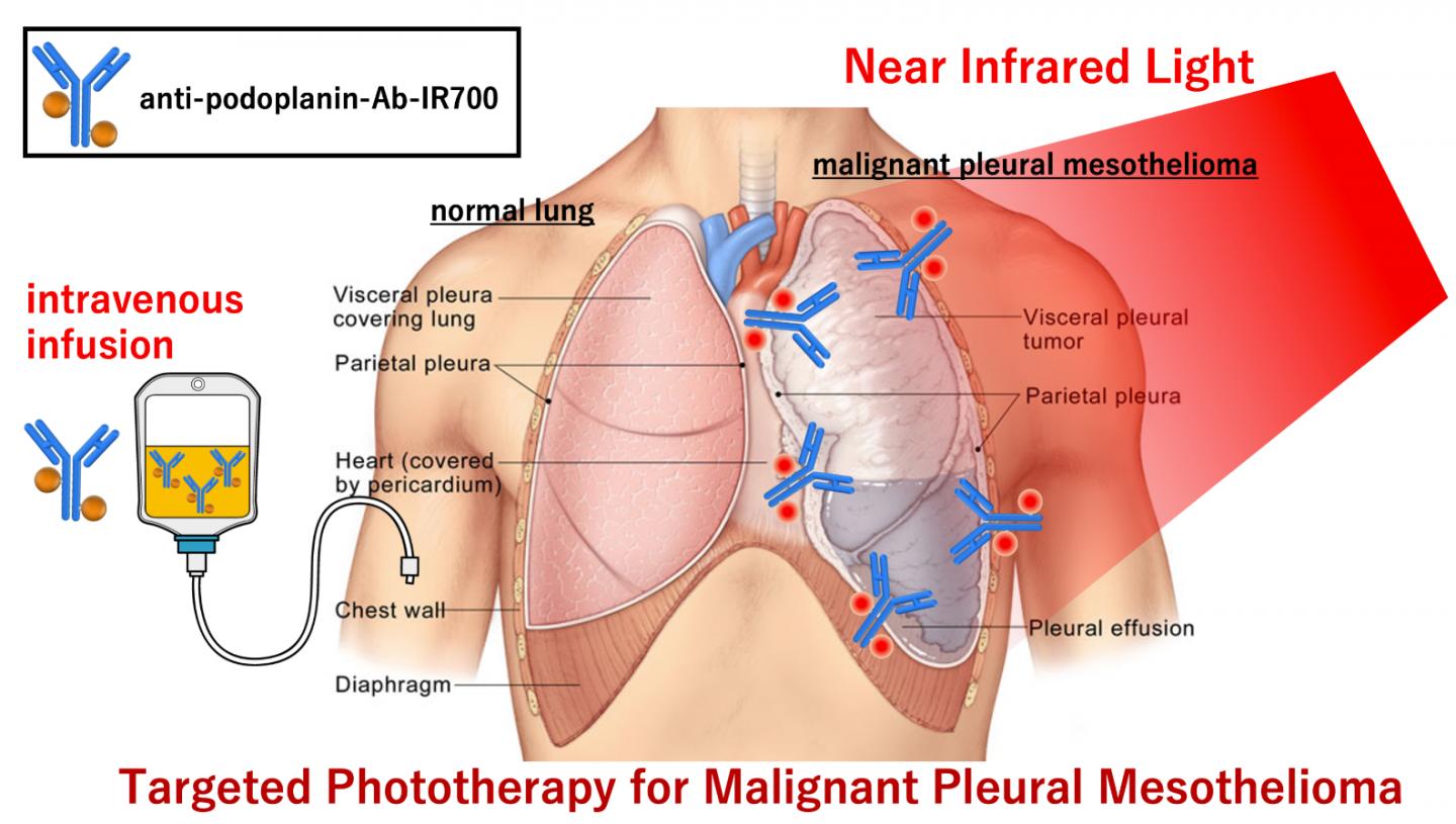 Fotoimmunoterapia promettente nella gestione di un raro tumore polmonare