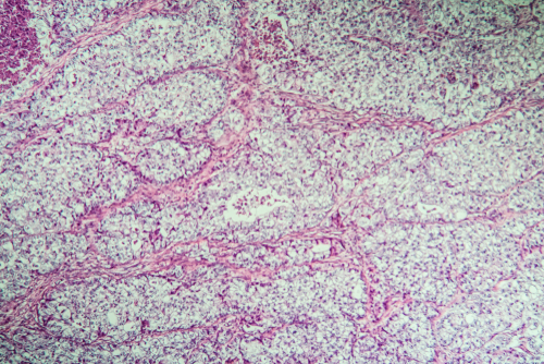 Prognosi sfavorevole nelle pazienti con carcinoma ovarico a cellule squamose