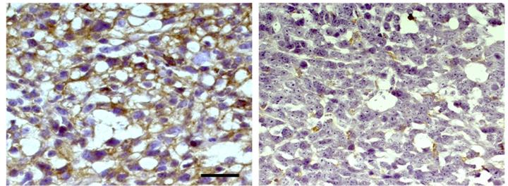 Glioblastoma: identificato un possibile target per ridurre l’evasione immunitaria