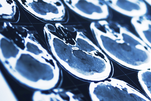 Tumore al seno: la diagnosi precoce delle metastasi cerebrali migliora la sopravvivenza