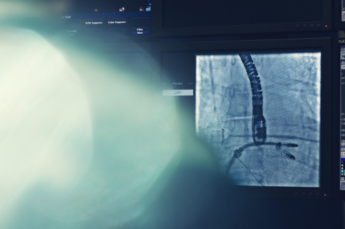 Rigurgito mitralico post-infartuale con shock cardiogeno: efficace MitraClip