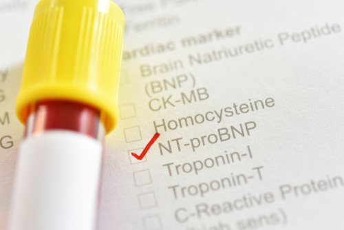 CoVid-19 senza insufficienza cardiaca: elevato NT-proBNP predice mortalità