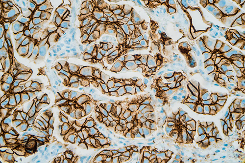 Tumore al seno: le cellule epiteliali possono influenzare lo sviluppo dei tumori HER2+