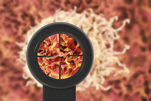 Car-T: il ruolo del microambiente tumorale nello sviluppo di tossicità