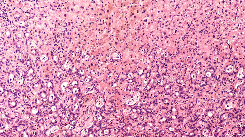 Identikit di ogni cellula del tumore al pancreas e dintorni