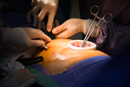 Profili postoperatori di ipercoagulabilità con toracotomia o toracoscopia assistita