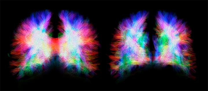 Agenesia del corpo calloso: grazie alla plasticità cerebrale 1/4 dei soggetti non presenta problemi cognitivi