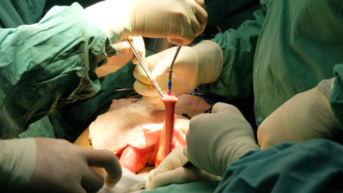 Resezione del colon: la massa muscolare influenza gli esiti dell’operazione