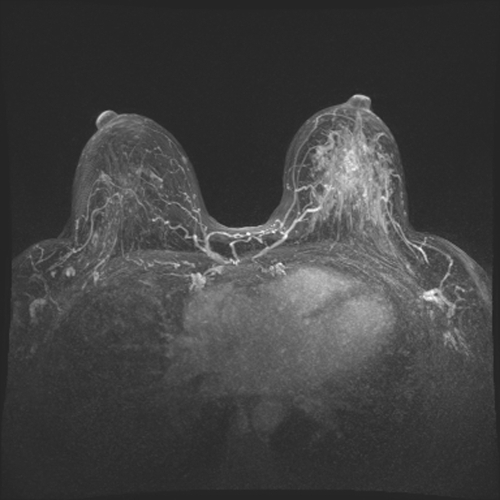 La risonanza magnetica abbreviata per identificare i tumori che sfuggono alla mammografia