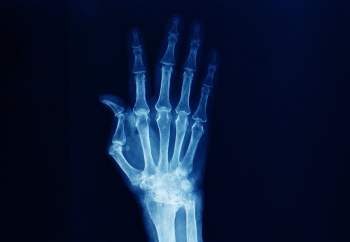 Nuovo trattamento contro l’artrite, usa la radiofrequenza 