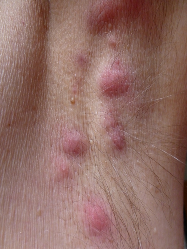 Congresso SIDeMaST. Idrosadenite: importante non interrompere le cure nonostante la pandemia