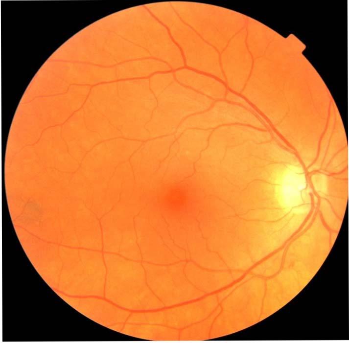 Diagnosi precoce del Parkinson grazie a un esame degli occhi