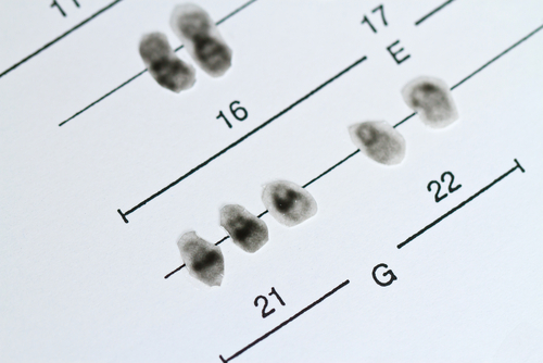 Alzheimer: la distribuzione della proteina tau nei pazienti con sindrome di Down