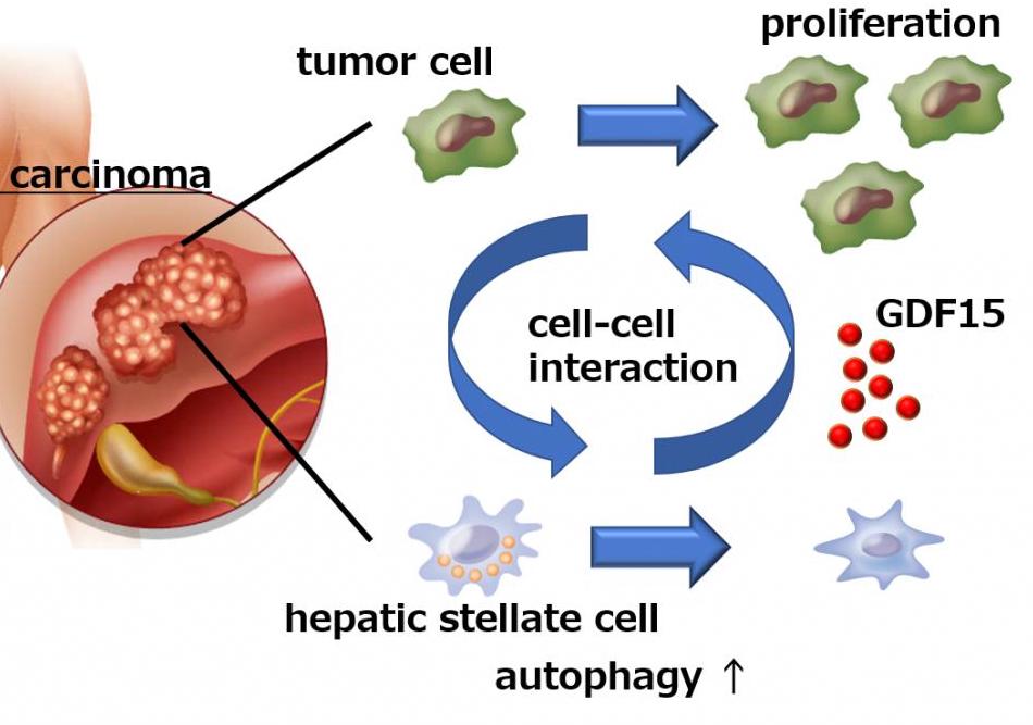Carcinoma epatocellulare: trattamento con anti-PD-1, terapia antiangiogenica e TAF
