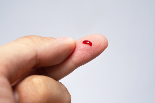 HIV: messo a punto test per carica virale da una singola goccia di sangue