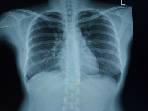 Malattia di Pompe: risonanza magnetica identifica precocemente debolezza diaframma