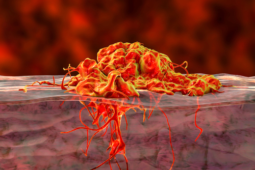 Tumore gastrico: il ruolo del TNF