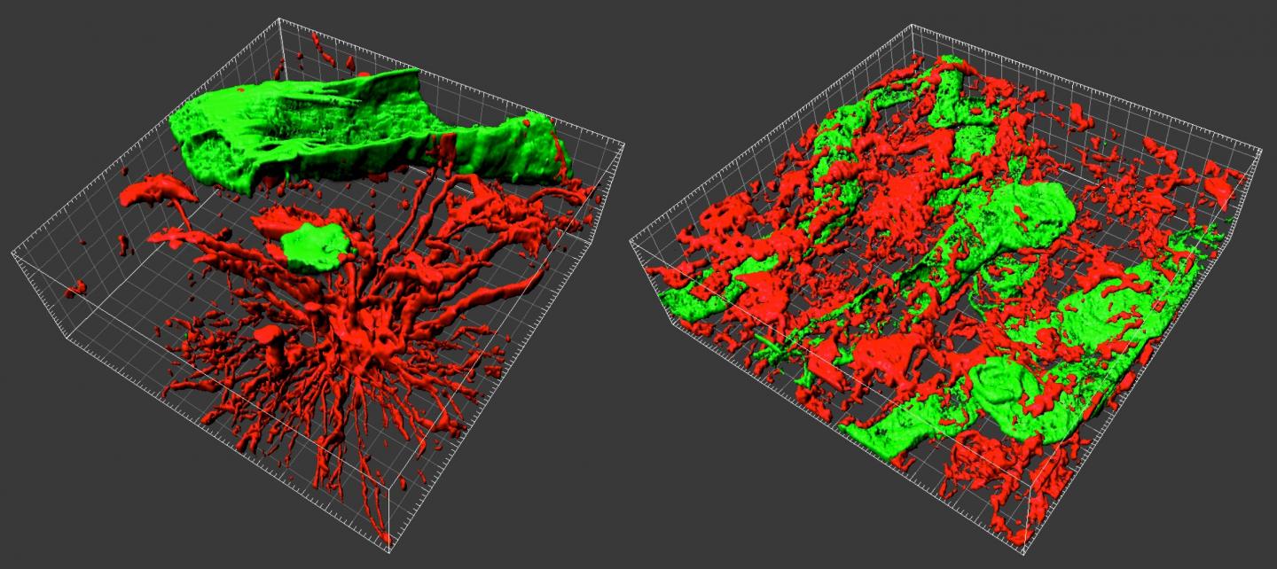 Un’analisi in 3D del glioblastoma