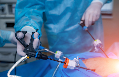 La chirurgia bariatrica può essere considerata una cura per il diabete di tipo 2 grave