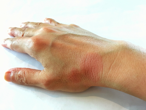 La carenza di vitamina D è legata a cambiamenti metabolici nei pazienti con lupus