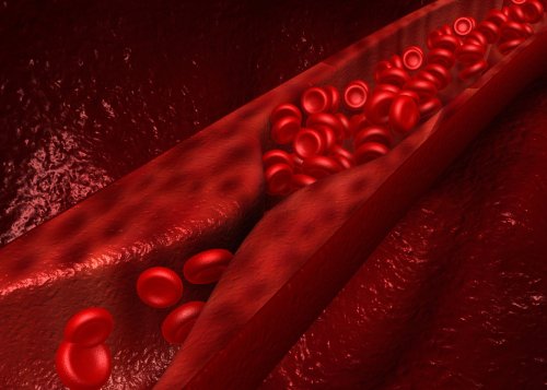 Valutazione della placca aterosclerotica femorale nei pazienti con psoriasi vs controlli sani
