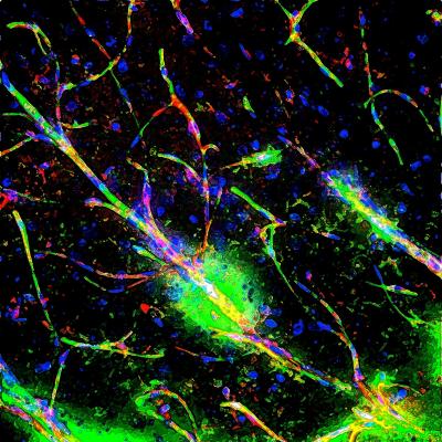 La barriera ematoencefalica compromessa nella schizofrenia