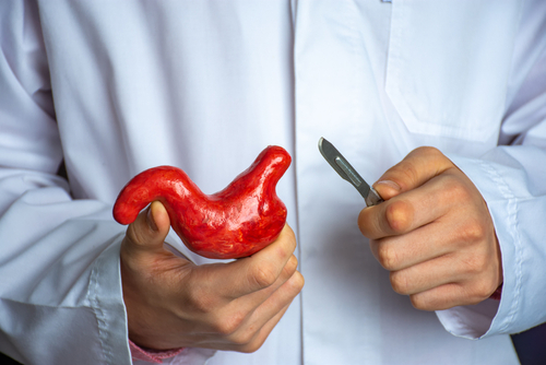 La chirurgia bariatrica non è associata ad un aumento del rischio del cancro al colon-retto