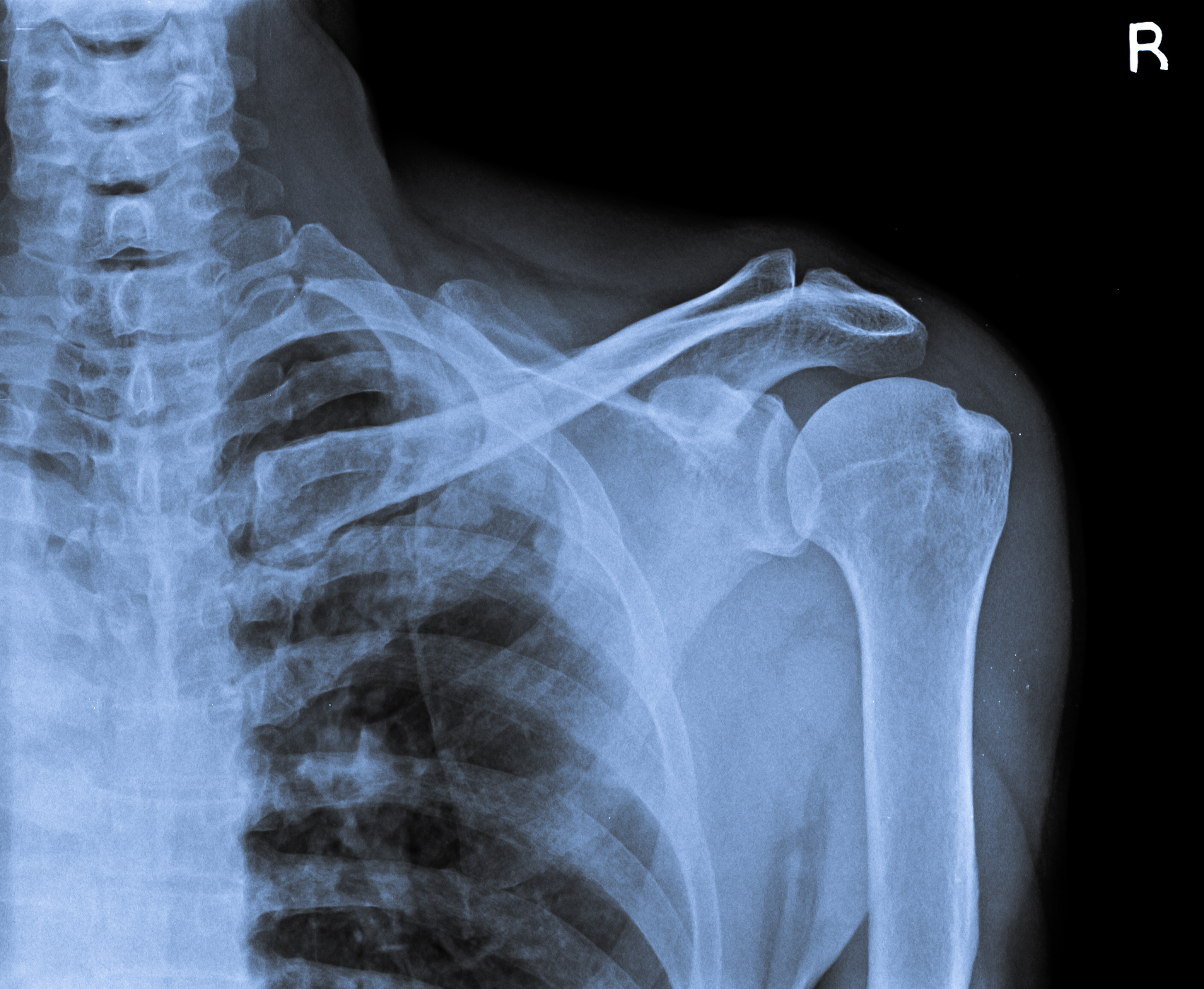 Osteoartrite acromioclavicolare: efficacia dei trattamenti