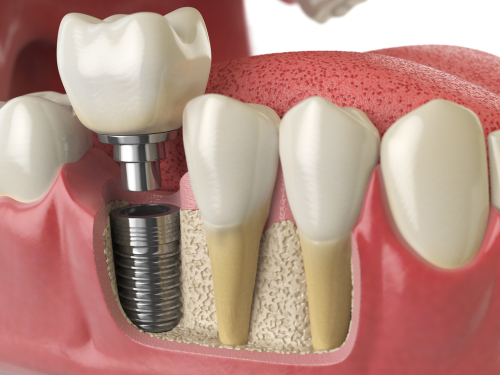 Materiali di rivestimento per prevenire l’allentamento delle viti di singoli impianti dentali