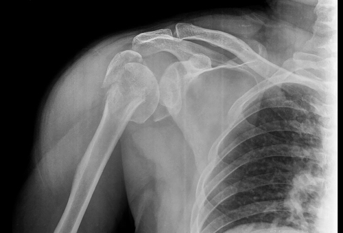 Chirurgia mininvasiva nella frattura dell’omero prossimale: molto promettente