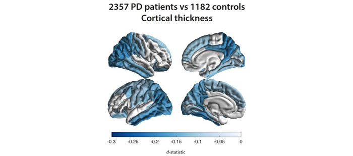 L’istituto USC avvia uno studio mondiale sulla malattia di Parkinson