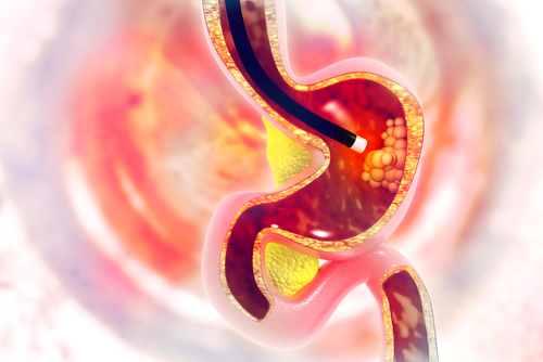 Terapia ablativa endoscopica: convalida ed efficacia