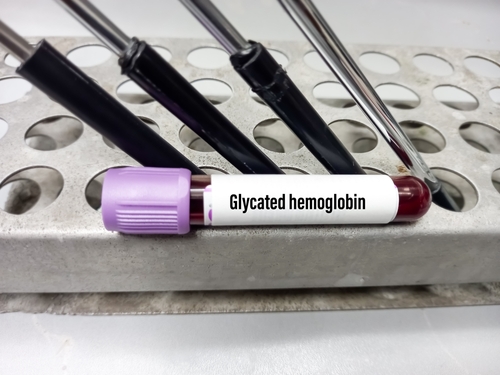 In pazienti diabetici dializzati, l’emoglobina glicata sottostima la glicemia media