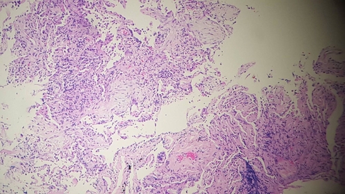 Emorragia alveolare diffusa: complicanza della microangiopatia trombotica