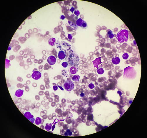 Ruxolitinib in prima linea nella linfoistiocitosi emofagocitica