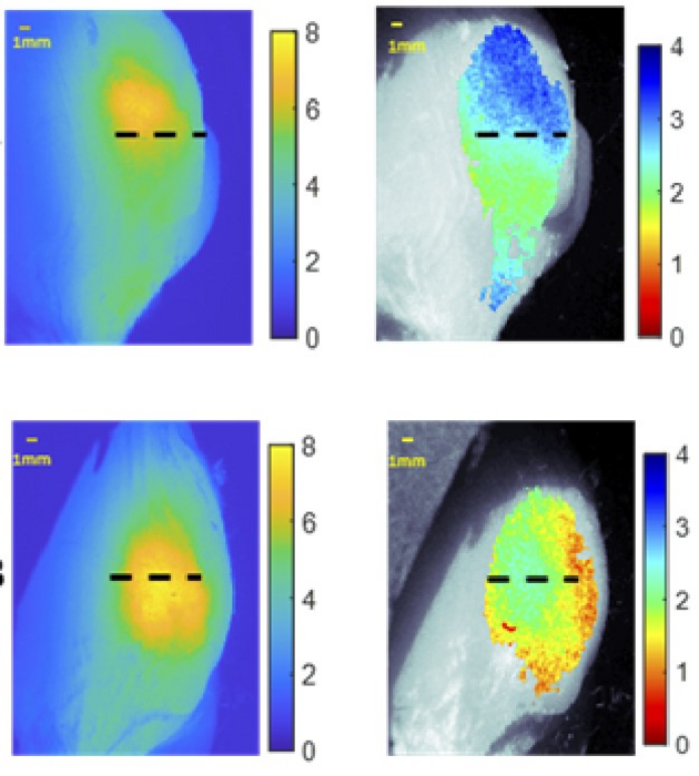 Imaging a fluorescenza per una migliore rimozione del tumore