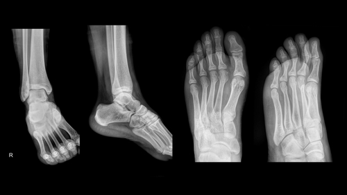 Fratture calcaneari intrarticolari: chirurgia mininvasiva dà buoni risultati 