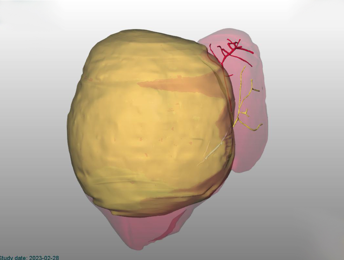 Asportato un tumore di 2 kg dal fegato di una bimba di 10 mesi e 8 kg di peso