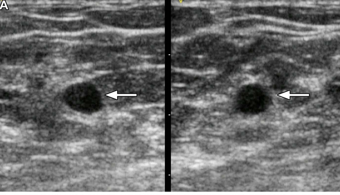 IA per valutare i noduli della mammella nelle aree con poche risorse