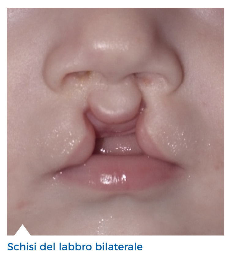 Labiopalatoschisi, Smile House: “In Italia curiamo il 65% dei bambini”