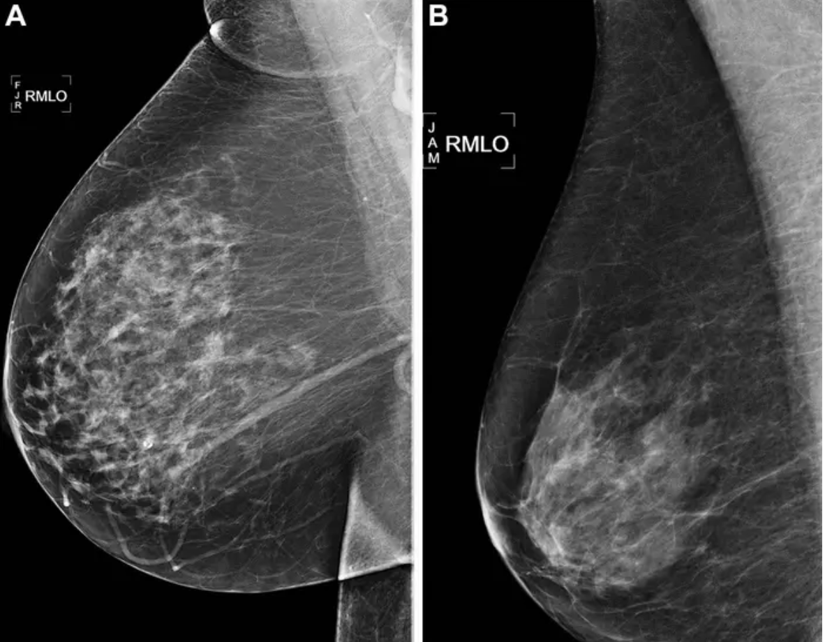 Cancro al seno: AI vs modello clinico per previsione del rischio a 5 anni