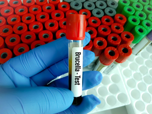 Complicanze della Brucellosi: aggiornamenti