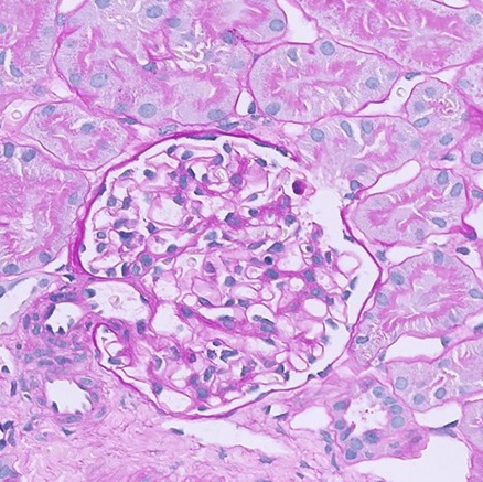 Sindrome nefrosica in età pediatrica, nuovo studio su Lancet per la gestione