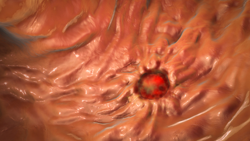 In caso di ulcera perforata la biopsia intraoperatoria potrebbe non avere reale utilità