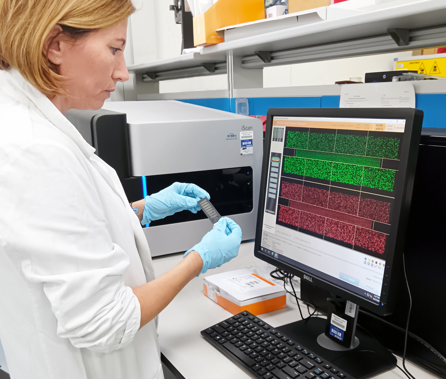 Scoperta la ‘firma molecolare’ dell’anemia di Fanconi