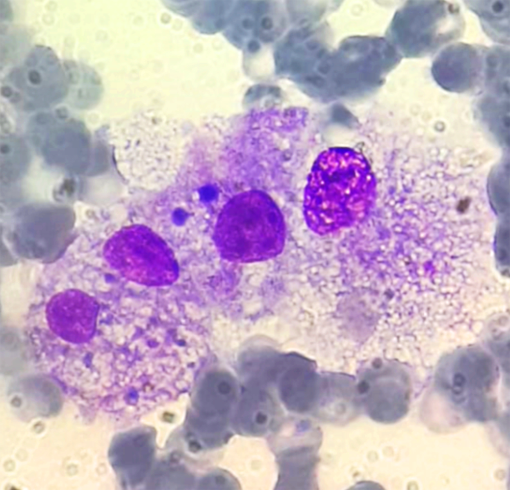 Malattie reumatiche: funziona la cura per la sindrome da attivazione macrofagica