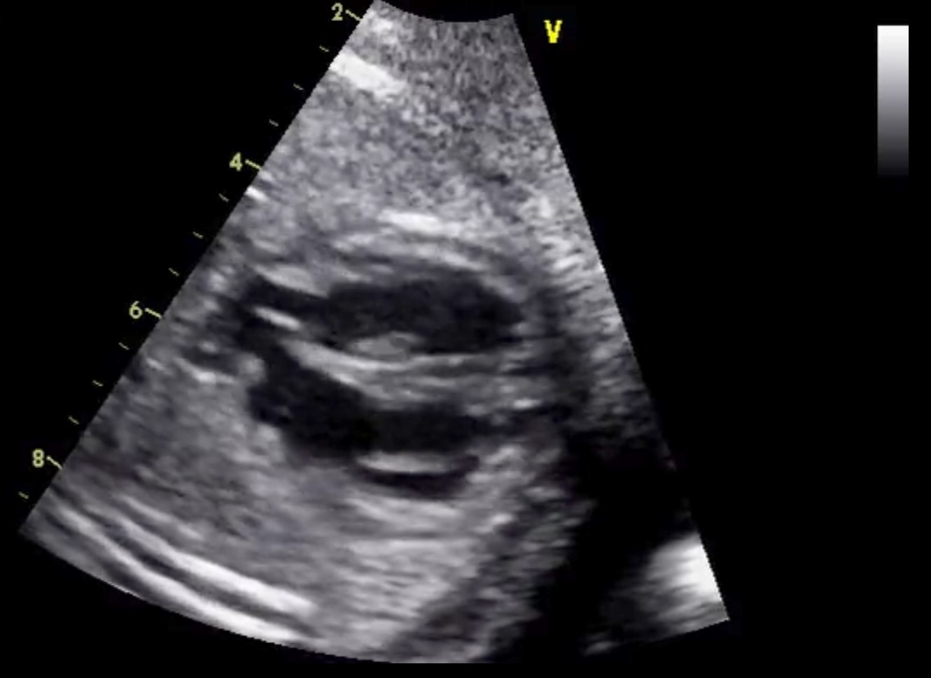 A Bergamo corso di aggiornamento per riconoscere precocemente le anomalie cardiache fetali