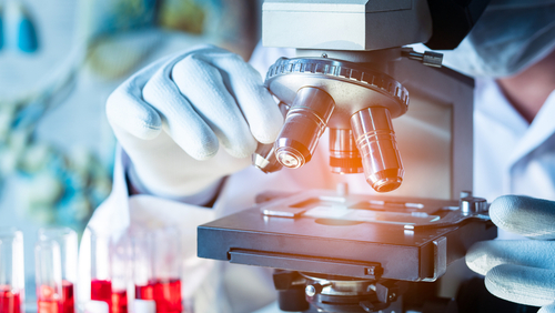 Analisi degli infiltrati delle cellule infiammatorie nel muscolo scheletrico dei pazienti con M. di Pompe